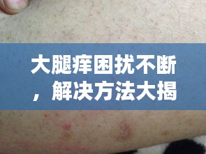 大腿痒困扰不断，解决方法大揭秘！